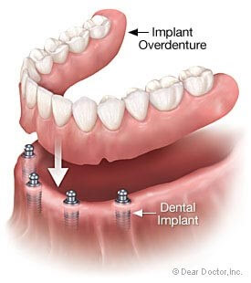 Dental Implants2